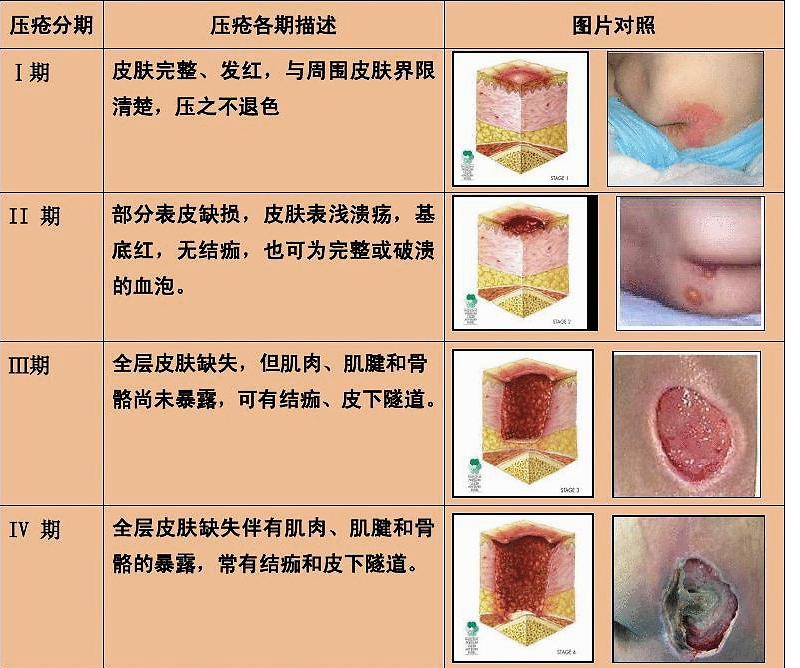 关于压疮的最新分期及其在护理实践中的应用（以2018年为例）